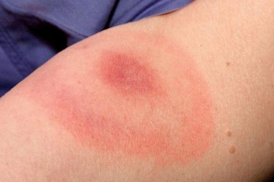 Gara-Gara Kutu, Ini Serba-Serbi Penyakit Lyme yang Perlu Dikenali